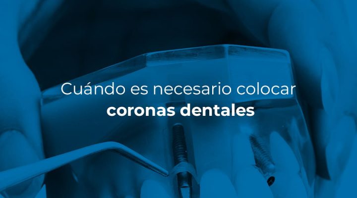 CoronasDentales