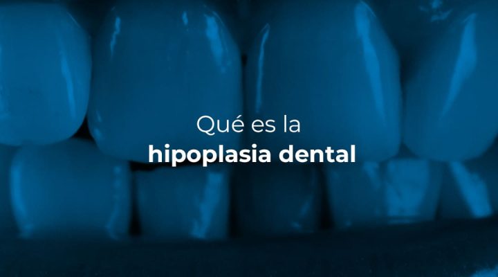 HipoplasiaDental