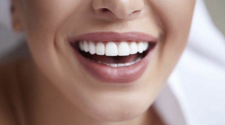 carillas-dentales-cosas-que-no-sabias