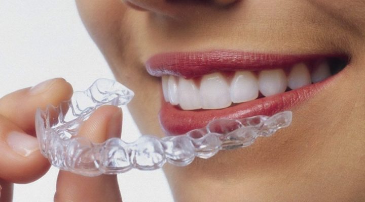 invisalign-porque-usar-tratamiento-1